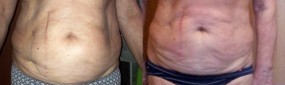 Brzuch - przed i po zabiegu Cavi-Lipo