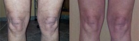 Okolice kolan - przed i po zabiegu Cavi-Lipo